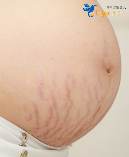 妊娠纹是怎么形成的？如何预防妊娠纹的产生?