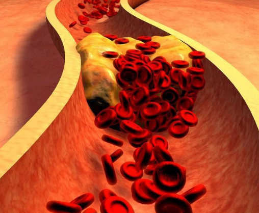 胆固醇对心血管疾病有风险，所有胆固醇都是坏胆固醇？