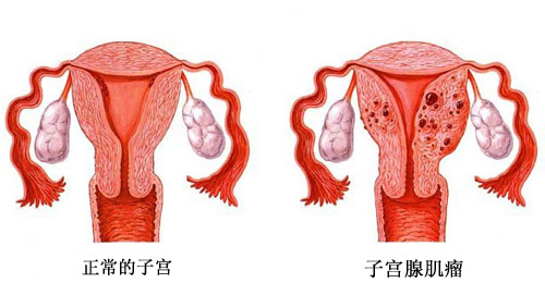 子宫腺肌瘤