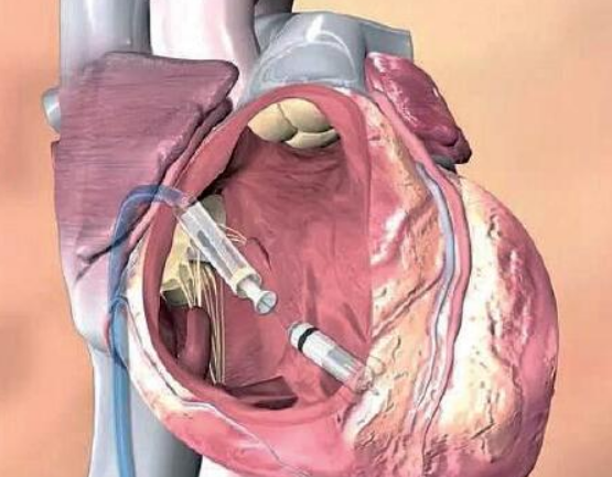 心脏导管插入术