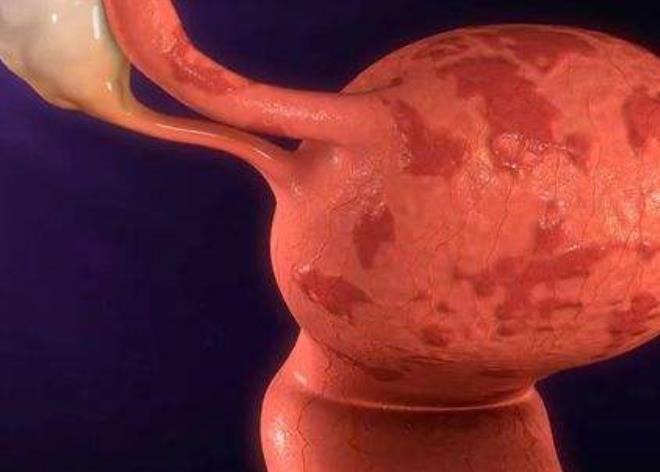 8大症状暗示子宫内膜异位症，不老实”的子宫内膜--子宫内膜异位症