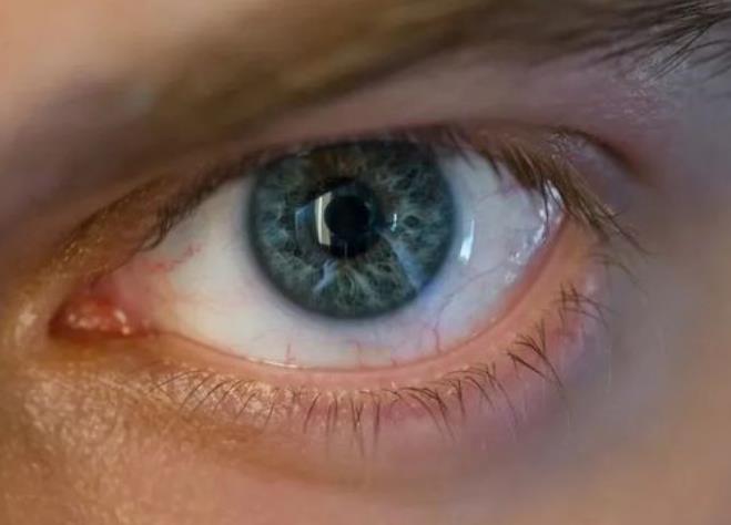 滴眼药水能不能治青光眼？青光眼该开刀还是吃药？怎么治疗最靠谱？