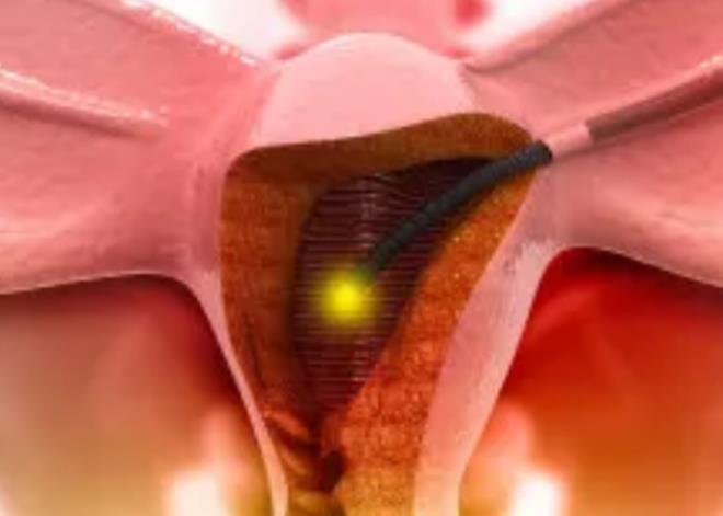 子宫内膜异位症有什么症状表现？子宫内膜异位症怎么检查出来的？