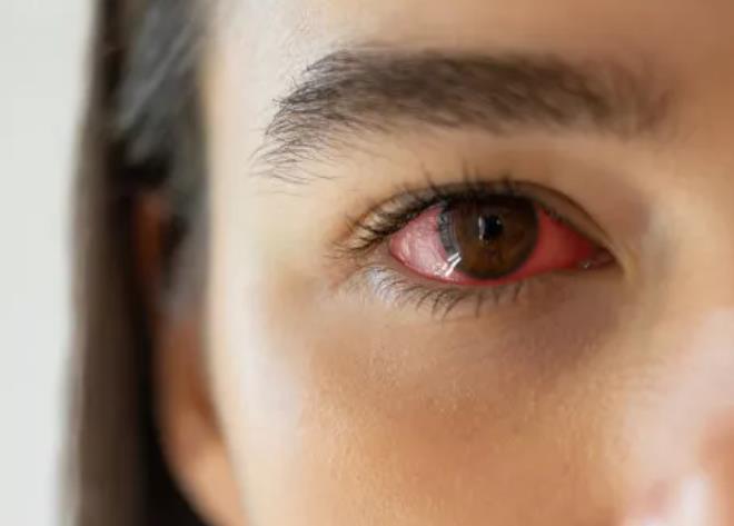 眼睛也会“缺水”，按摩、眨眼、热敷有利于缓解干眼症